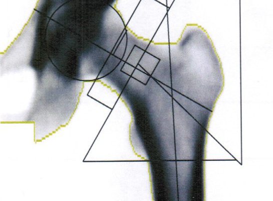 Diagnostyka i kryteria rozpoznania osteoporozy