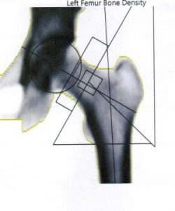 Diagnostyka i kryteria rozpoznania osteoporozy